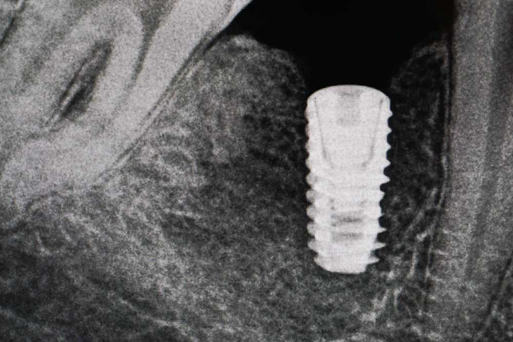 impl-3.jpg impl-3.jpg
